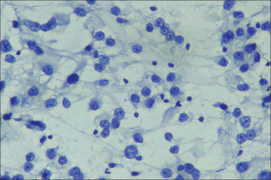 Pemphigus in Sarcomatoid Renal Cell Carcinoma: A Rare Paraneoplastic Manifestation.