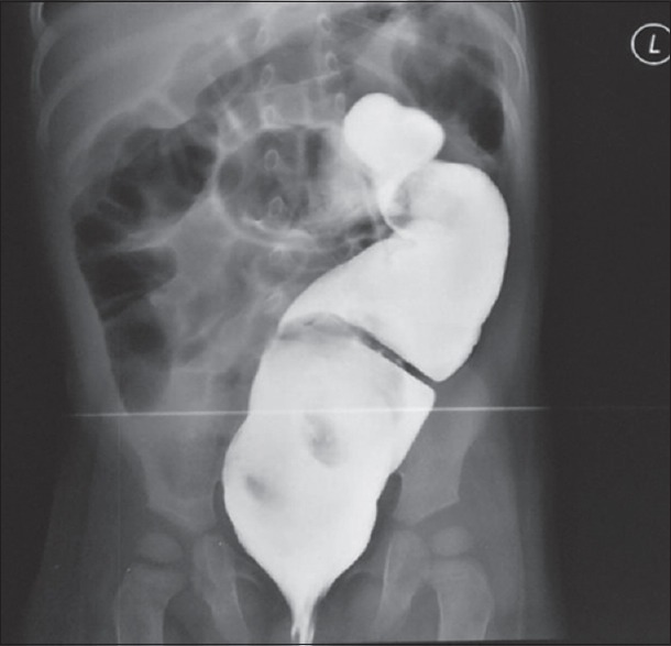 Laparoscopy-assisted Transanal Endorectal Pull-through for the Management of Hirschsprung's Disease in Nigeria: Report of Two Cases.