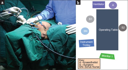 Laparoscopy-assisted Transanal Endorectal Pull-through for the Management of Hirschsprung's Disease in Nigeria: Report of Two Cases.