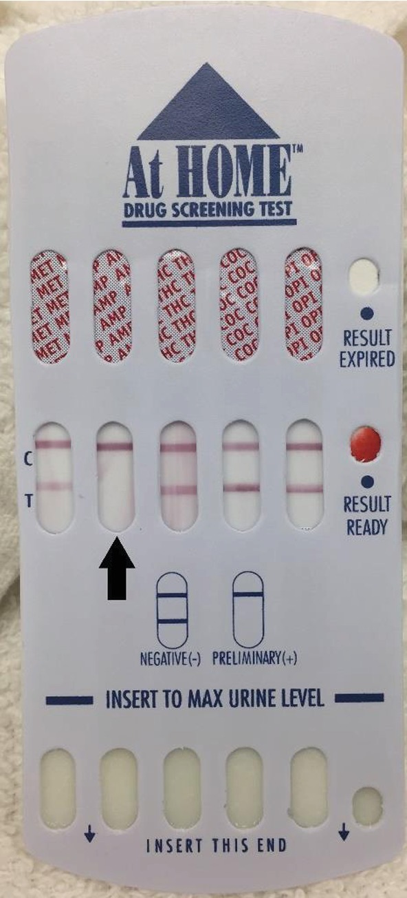 Severe Rhabdomyolysis Associated with Acute Amphetamine Toxicosis in a Dog.