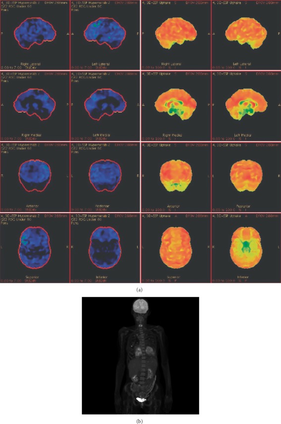 Intravascular Lymphoma with Progressive CNS Hemorrhage and Multiple Dissections.