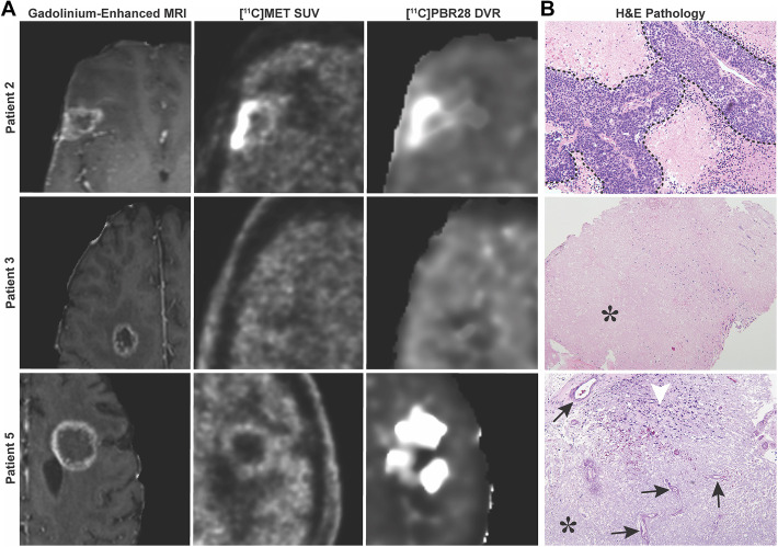 [<sup>11</sup>C]Methionine and [<sup>11</sup>C]PBR28 as PET Imaging Tracers to Differentiate Metastatic Tumor Recurrence or Radiation Necrosis.