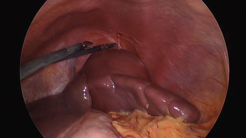 Laparoscopic Partial Splenectomy Assisted by Fluorescence in a 13-Year-Old Girl.