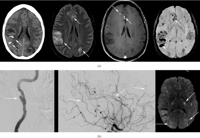 Intravascular Lymphoma with Progressive CNS Hemorrhage and Multiple Dissections.