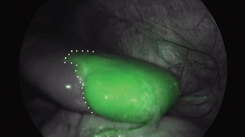 Laparoscopic Partial Splenectomy Assisted by Fluorescence in a 13-Year-Old Girl.