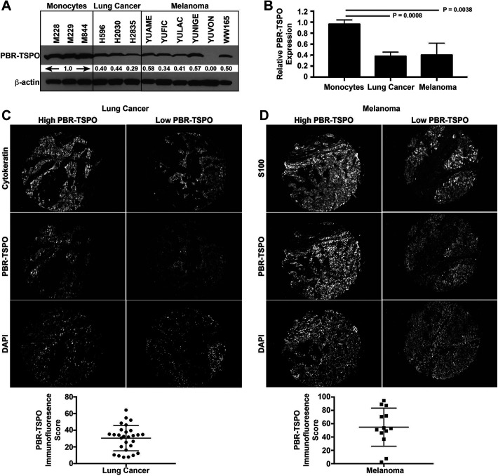 [<sup>11</sup>C]Methionine and [<sup>11</sup>C]PBR28 as PET Imaging Tracers to Differentiate Metastatic Tumor Recurrence or Radiation Necrosis.