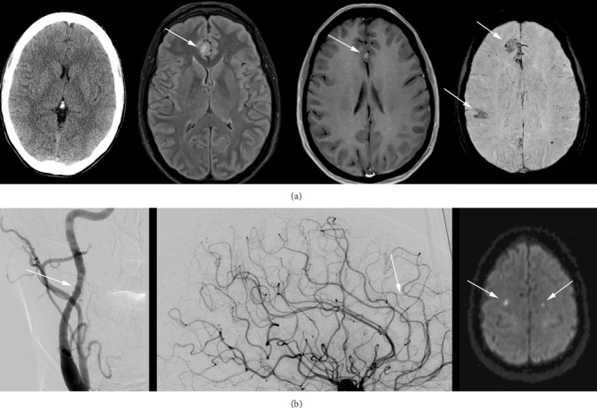 Intravascular Lymphoma with Progressive CNS Hemorrhage and Multiple Dissections.