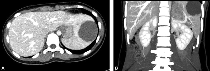 Laparoscopic Partial Splenectomy Assisted by Fluorescence in a 13-Year-Old Girl.