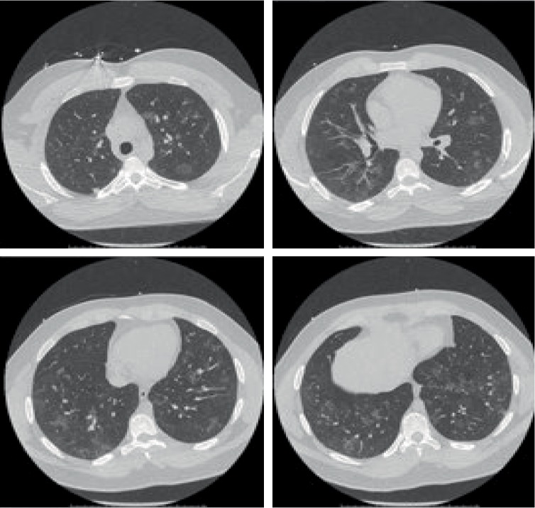 Vaping Is Not Safe: A Case of Acute Eosinophilic Pneumonia following Cannabis Vapor Inhalation.