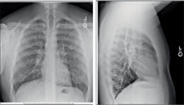 Vaping Is Not Safe: A Case of Acute Eosinophilic Pneumonia following Cannabis Vapor Inhalation.