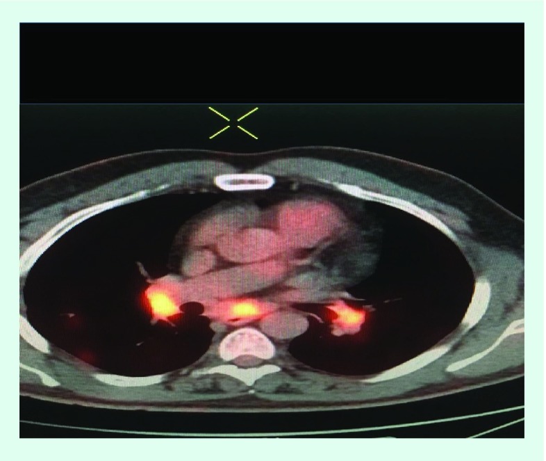 Convex endobronchial ultrasound: same coin, two faces. Challenging biopsy and staging for non-small-cell lung cancer.