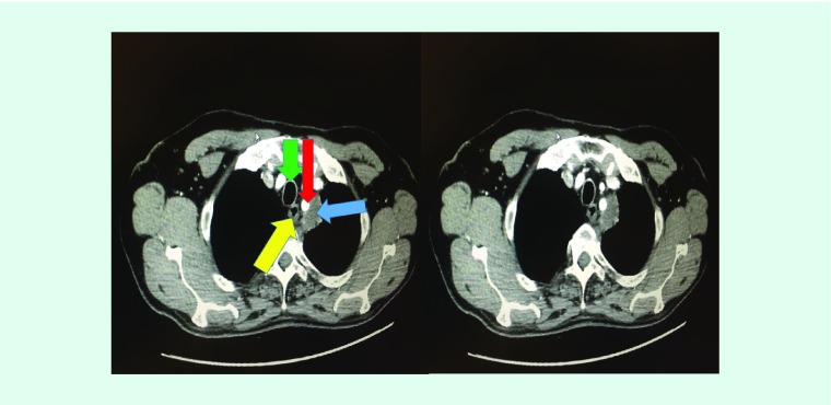 Convex endobronchial ultrasound: same coin, two faces. Challenging biopsy and staging for non-small-cell lung cancer.