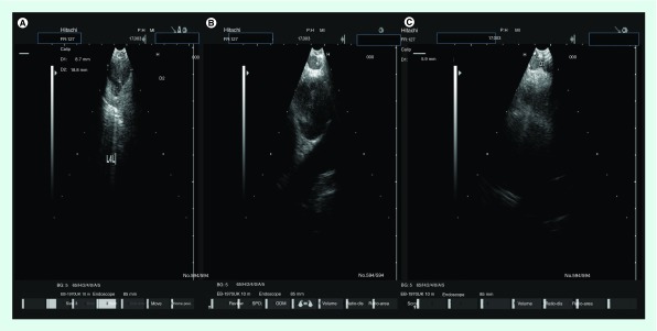 Convex endobronchial ultrasound: same coin, two faces. Challenging biopsy and staging for non-small-cell lung cancer.