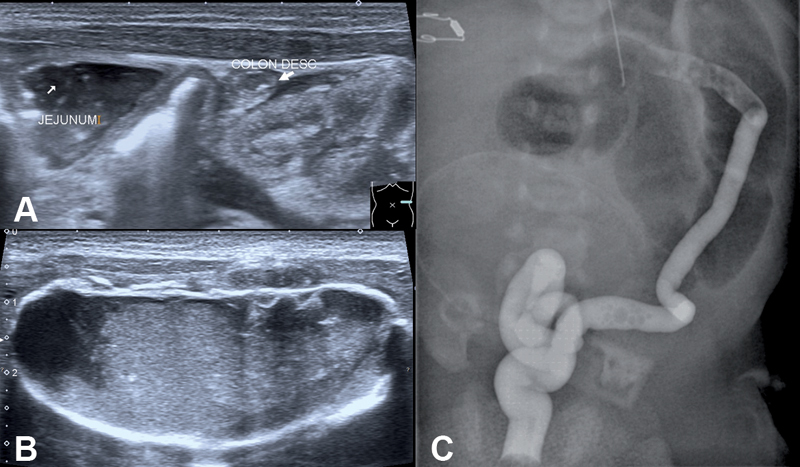 Image of the Month: Meconium Peritonitis with Pseudocyst-A Spot Diagnosis in Newborns.