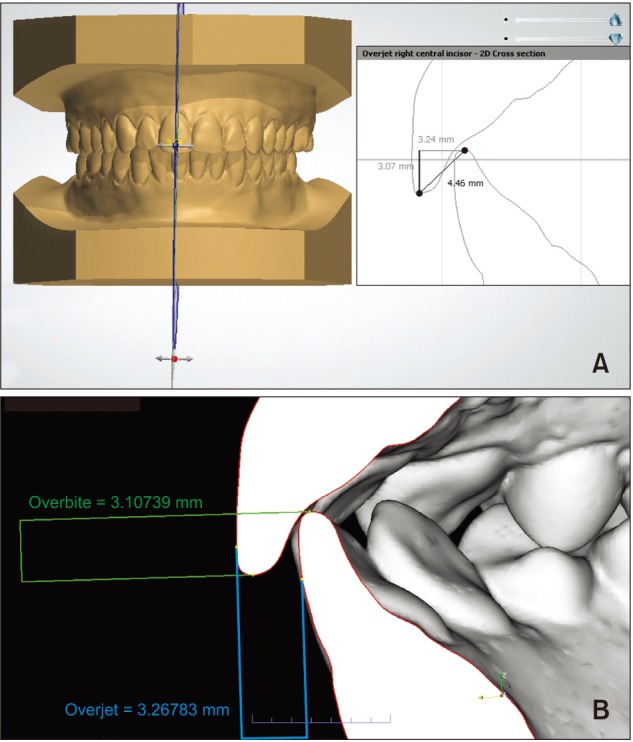 Accuracy and reliability of measurements performed using two different software programs on digital models generated using laser and computed tomography plaster model scanners.