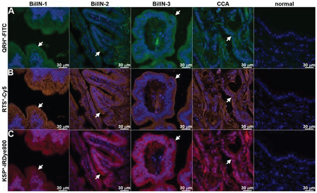 Multiplexed Imaging Strategy to Distinguish Indeterminant Biliary Strictures: An <i>Ex Vivo</i> Study.