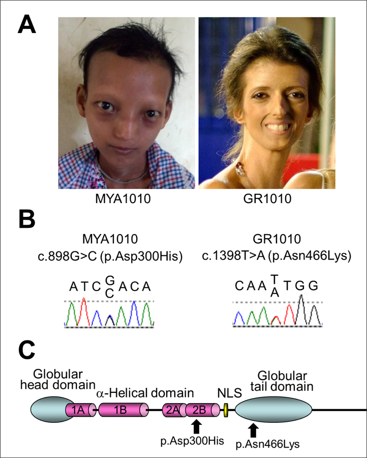 Novel LMNA mutations in Greek and Myanmar Patients with Progeroid Features and Cardiac Manifestations.