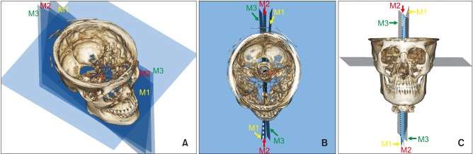 Comparison of three midsagittal planes for three-dimensional cone beam computed tomography head reorientation.