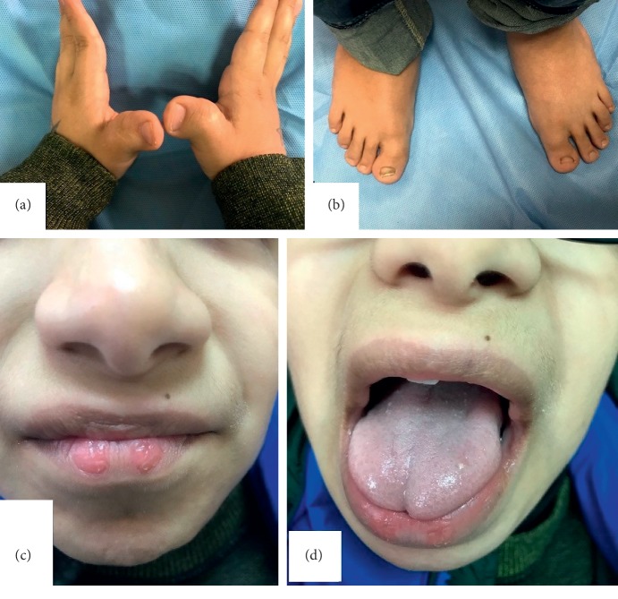 Chromosome 16p13.3 Contiguous Gene Deletion Syndrome including the <i>SLX4</i>, <i>DNASE1</i>, <i>TRAP1</i>, and <i>CREBBP</i> Genes Presenting as a Relatively Mild Rubinstein-Taybi Syndrome Phenotype: A Case Report of a Saudi Boy.