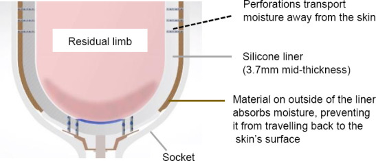 Using Perforated Liners to Combat the Detrimental Effects of Excessive Sweating in Lower Limb Prosthesis Users.