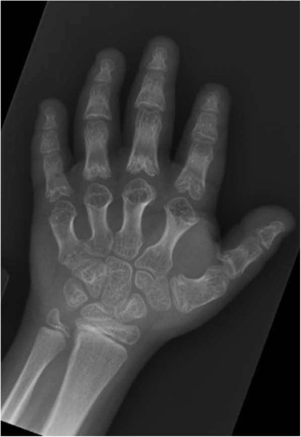 Legg-Calve-Perthes disease in an 8-year old girl with Acrodysostosis type 1 on growth hormone therapy: case report.