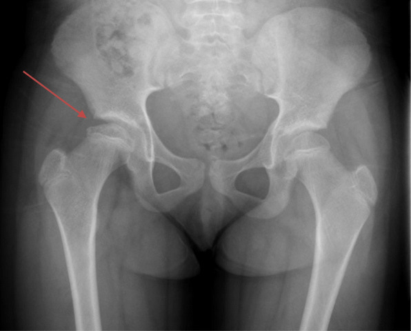 Legg-Calve-Perthes disease in an 8-year old girl with Acrodysostosis type 1 on growth hormone therapy: case report.