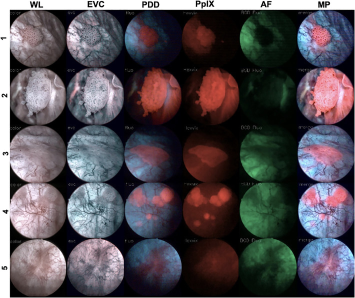 Multi-Wavelength Fluorescence in Image-Guided Surgery, Clinical Feasibility and Future Perspectives.