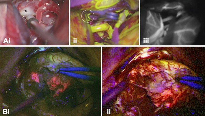 Multi-Wavelength Fluorescence in Image-Guided Surgery, Clinical Feasibility and Future Perspectives.