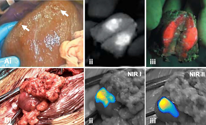 Multi-Wavelength Fluorescence in Image-Guided Surgery, Clinical Feasibility and Future Perspectives.