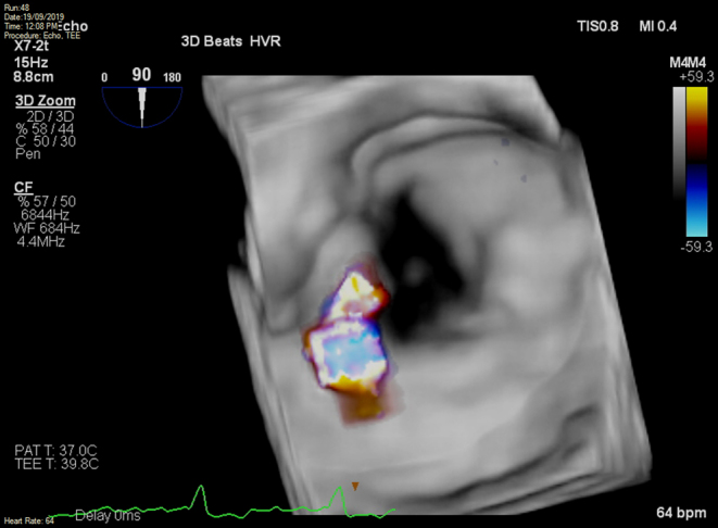 Coming undone: annuloplasty ring suture degeneration post mitral valve repair.