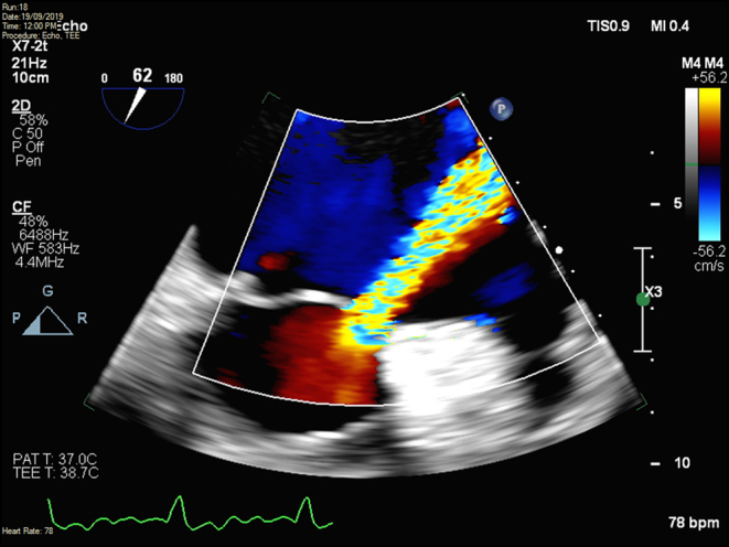 Coming undone: annuloplasty ring suture degeneration post mitral valve repair.