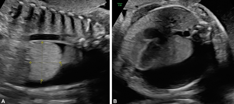 Combined Pre- and Postnatal Minimally Invasive Approach to Complicated Pulmonary Sequestrations.