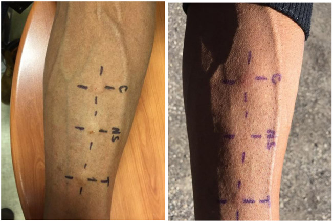 Exaggerated Immune Reaction to Trichophyton Fungus Results in an Inflammatory Tinea Pedis.