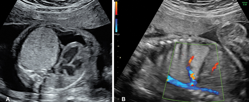 Combined Pre- and Postnatal Minimally Invasive Approach to Complicated Pulmonary Sequestrations.