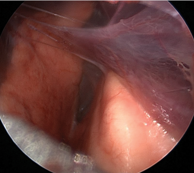 Combined Pre- and Postnatal Minimally Invasive Approach to Complicated Pulmonary Sequestrations.