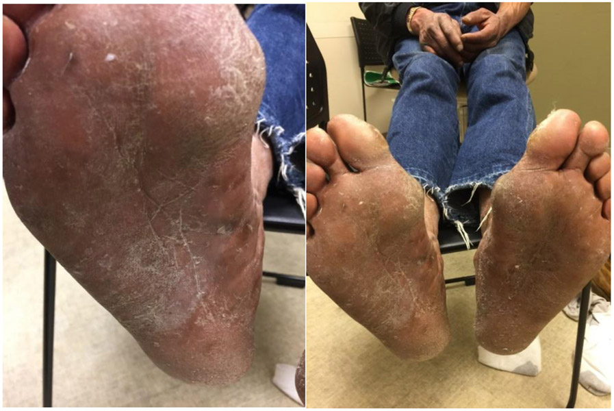 Exaggerated Immune Reaction to Trichophyton Fungus Results in an Inflammatory Tinea Pedis.