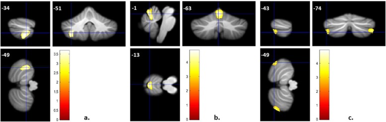 Abnormal cerebellar volume in somatic vs. non-somatic delusional disorders.