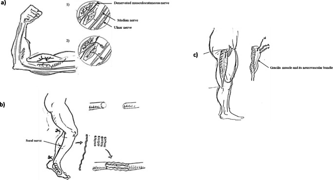 Strategies for Peripheral Nerve Repair.