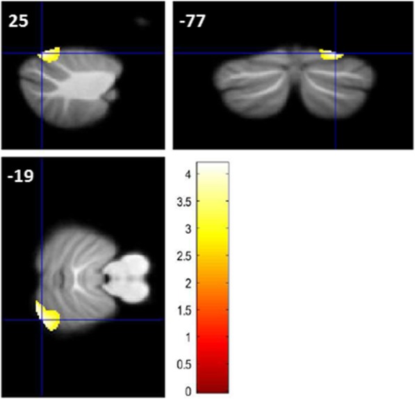 Abnormal cerebellar volume in somatic vs. non-somatic delusional disorders.