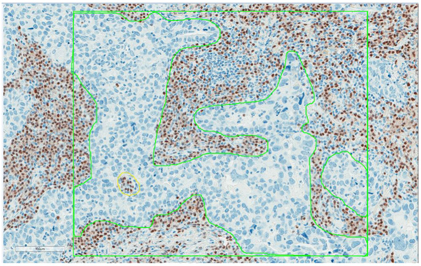 Increased Plasma Cells and Decreased B-cells in Tumor Infiltrating Lymphocytes are Associated with Worse Survival in Lung Adenocarcinomas.