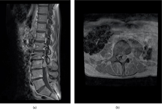 Ominous Occurrence of Spinal Intradural Primary Malignant Peripheral Nerve Sheath Tumor Four Decades following Radiation Therapy for Testicular Seminoma.