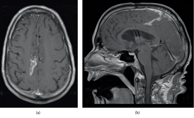 Ominous Occurrence of Spinal Intradural Primary Malignant Peripheral Nerve Sheath Tumor Four Decades following Radiation Therapy for Testicular Seminoma.