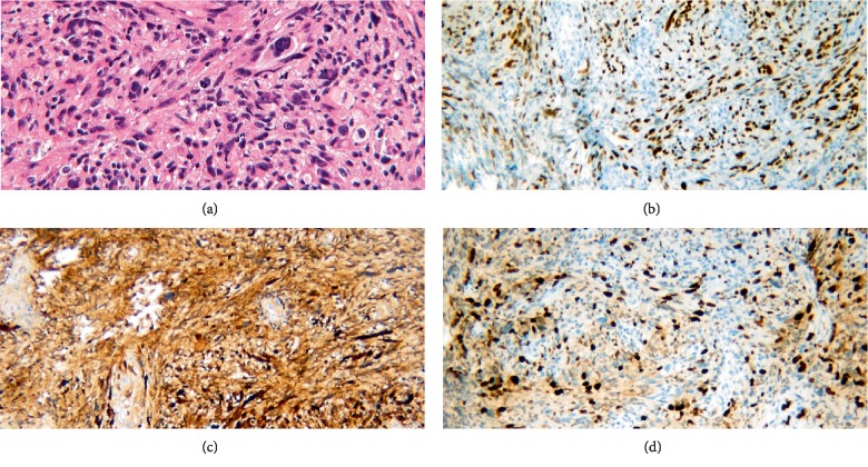 Ominous Occurrence of Spinal Intradural Primary Malignant Peripheral Nerve Sheath Tumor Four Decades following Radiation Therapy for Testicular Seminoma.