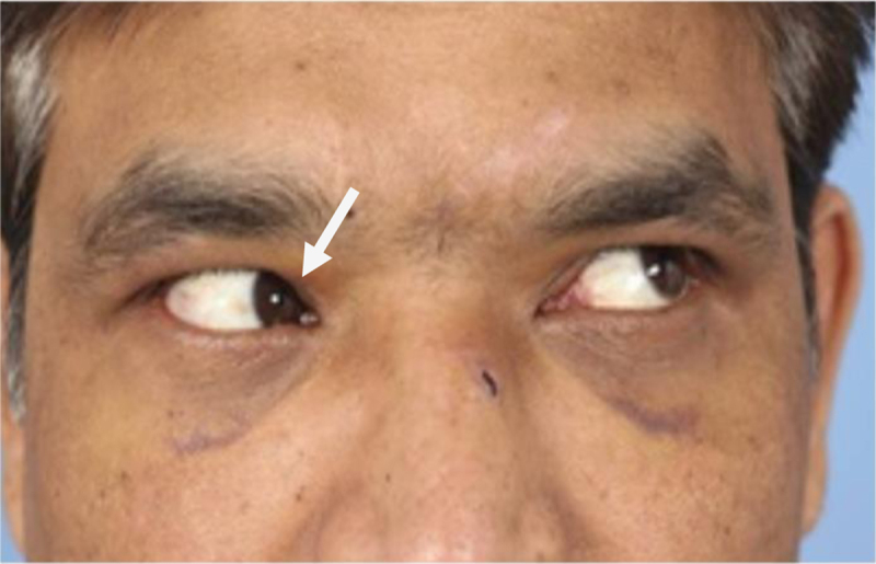 Acquired Brown Syndrome in Head Trauma: Does Fixation of Associated Nasal and Frontal Bone Fractures Provide a Cure?