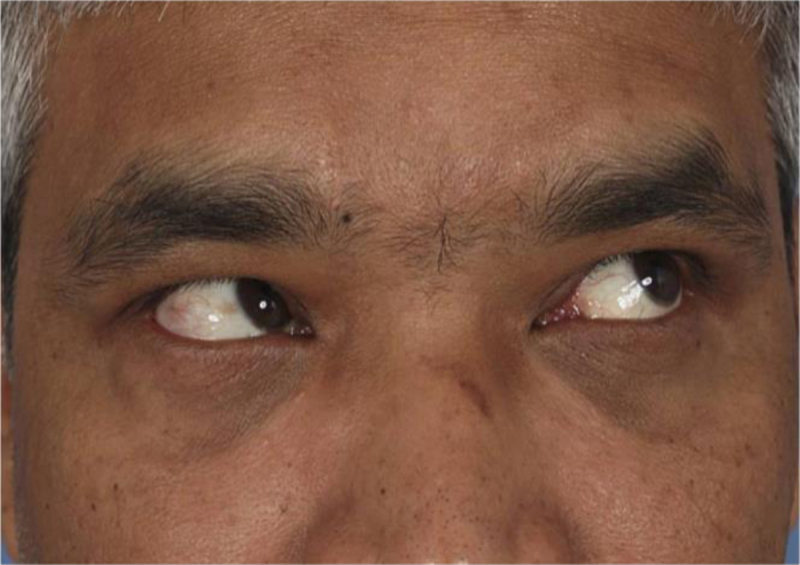 Acquired Brown Syndrome in Head Trauma: Does Fixation of Associated Nasal and Frontal Bone Fractures Provide a Cure?