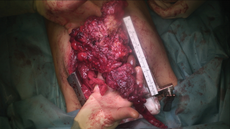 Complete Resection of a Large Mediastinal Calcifying Fibrous Tumor.