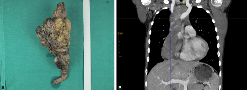 Complete Resection of a Large Mediastinal Calcifying Fibrous Tumor.