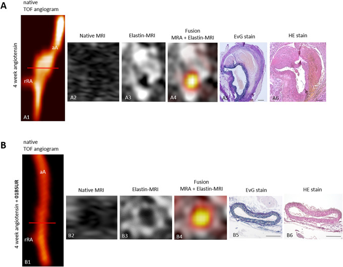 Molecular MR-Imaging for Noninvasive Quantification of the Anti-Inflammatory Effect of Targeting Interleukin-1β in a Mouse Model of Aortic Aneurysm.