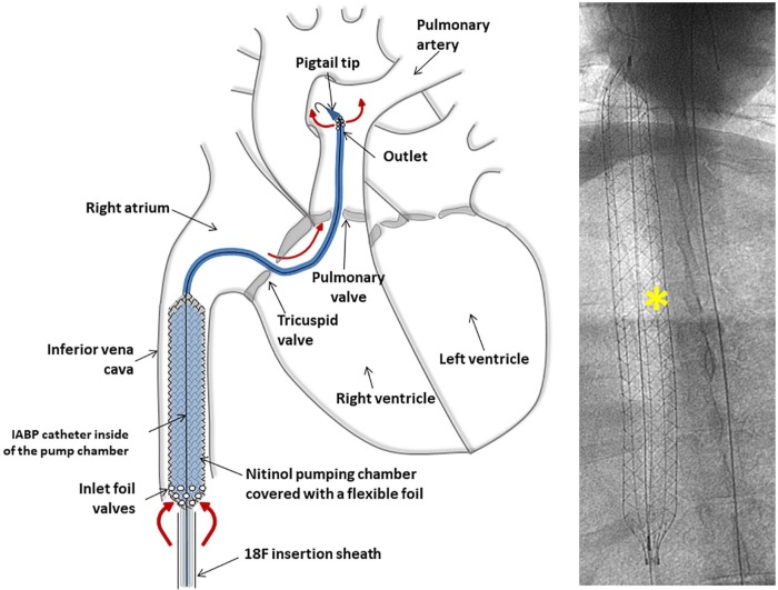 Acute right heart failure: future perspective with the PERKAT RV pulsatile right ventricular support device.