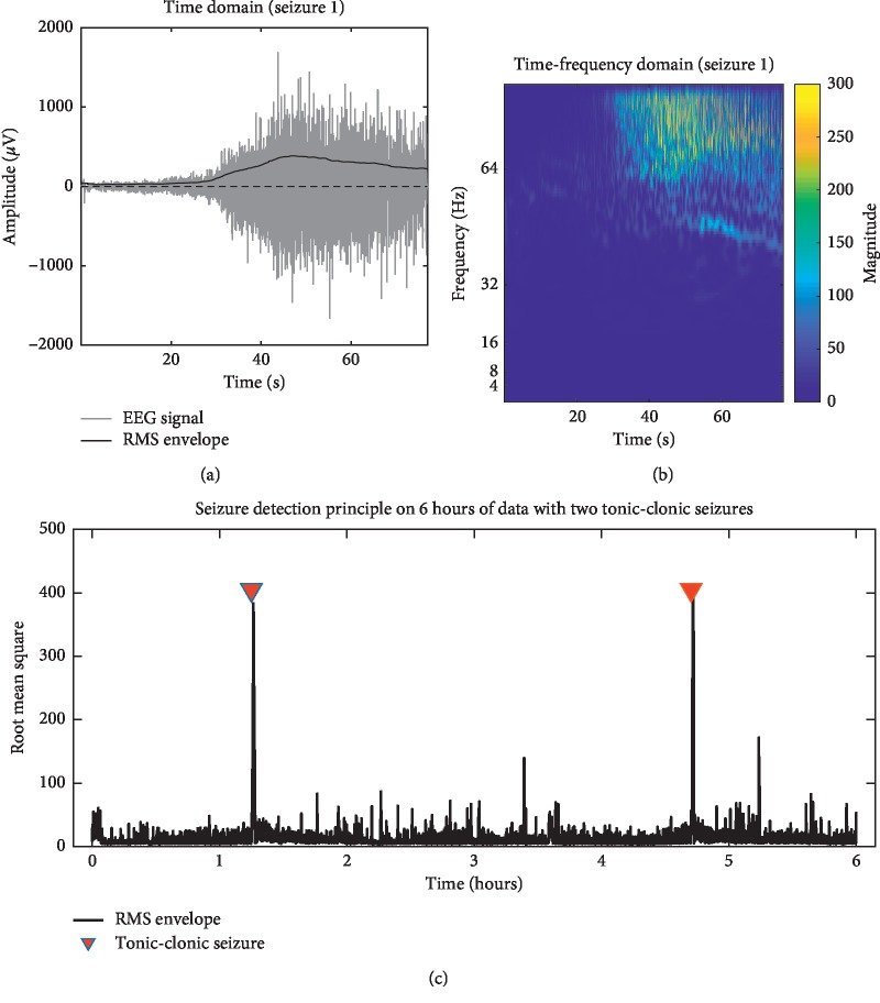 Subcutaneous EEG Monitoring Reveals AED Response and Breakthrough Seizures.